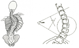 Skoliose